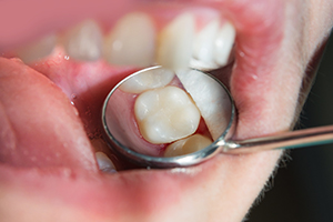 Getting a Cavity Filled | Robert Pearce, DDS | Point Richmond, CA