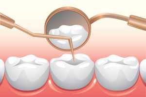 Dental Prevention Checkups