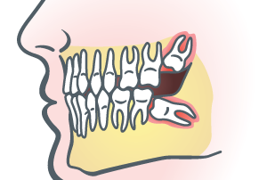 Impacted Wisdom Teeth