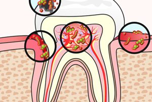 Tooth Section with Damage and Germs